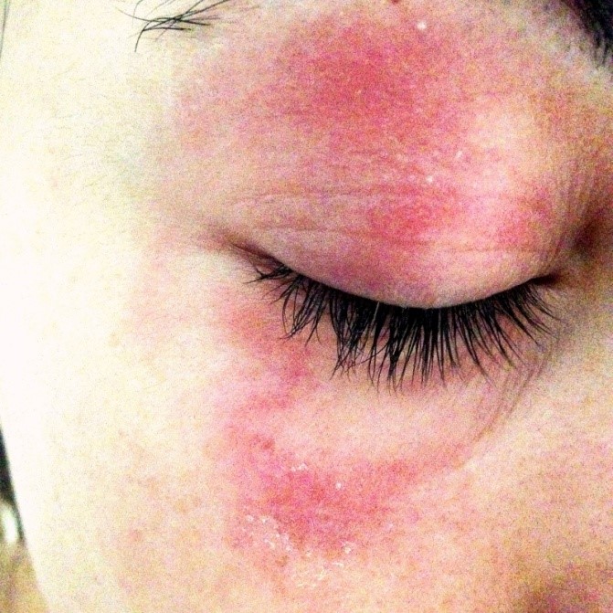 7 Causes of Skin Allergies - FBIO